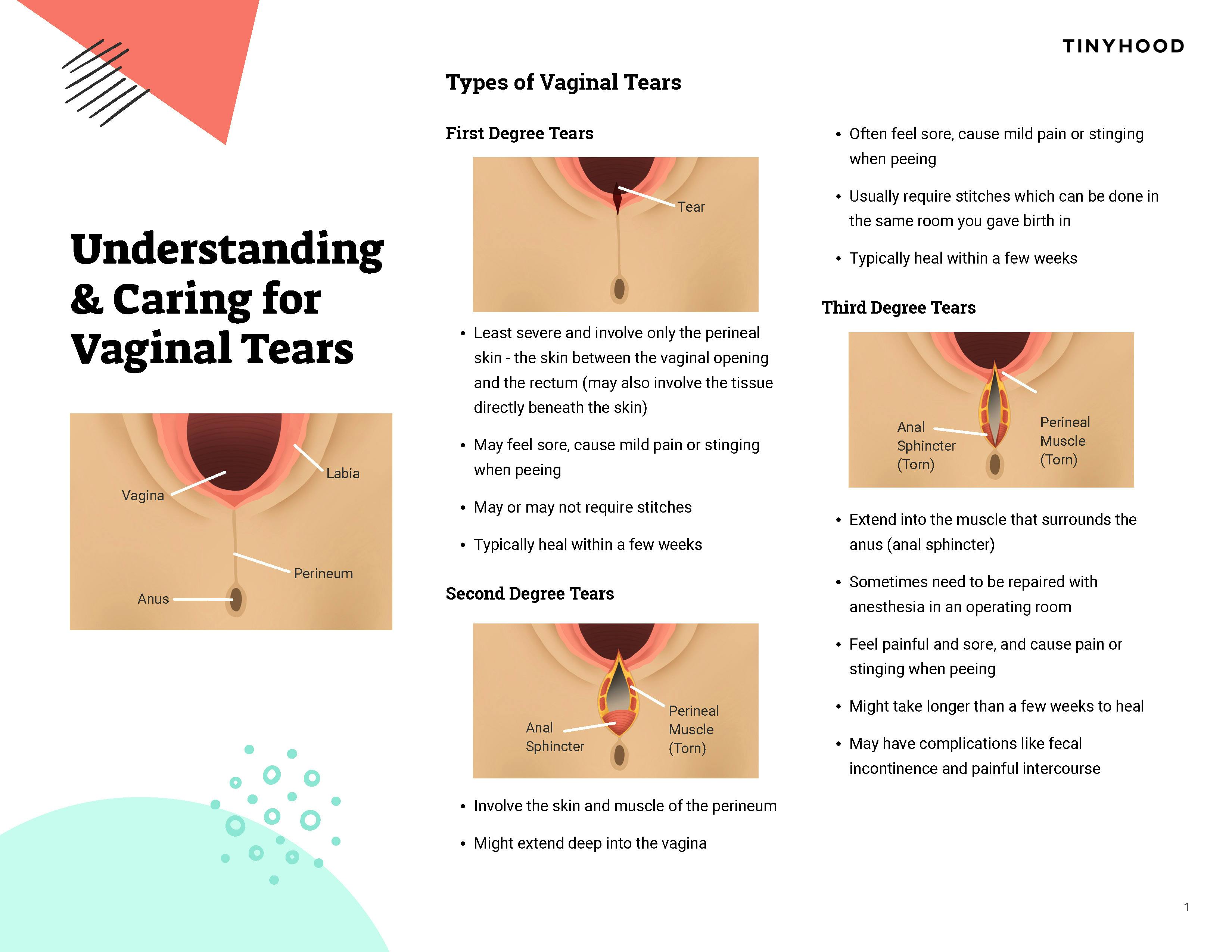 Preview image of Handout: Understanding & Caring for Vaginal Tears